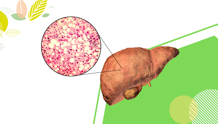 Identifying Fatty Liver Symptoms