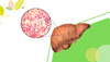 Identifying Fatty Liver Symptoms