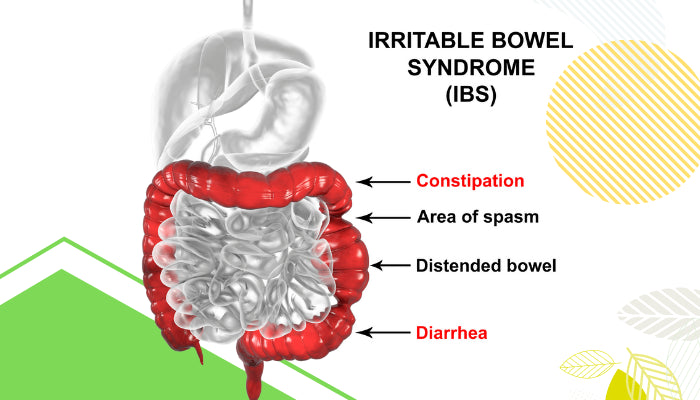 IBS Treatment: Causes, Symptoms, and Medications